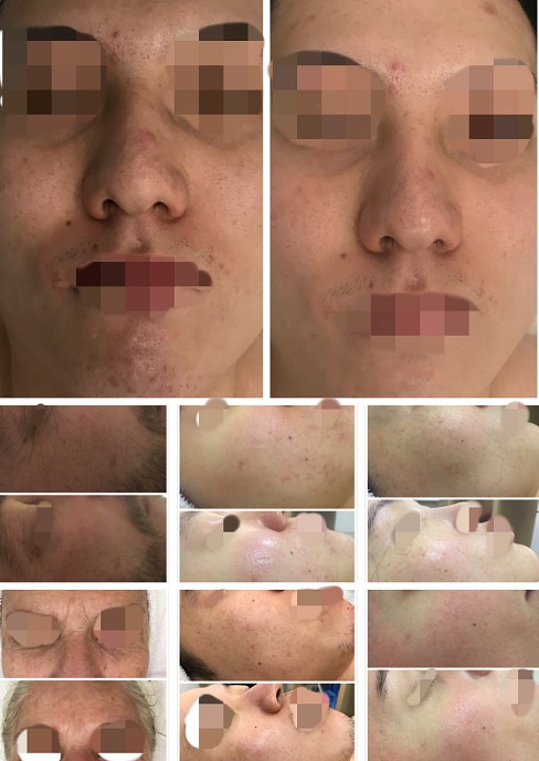 resultados de tratamiento carita paris facial madrid.jpg